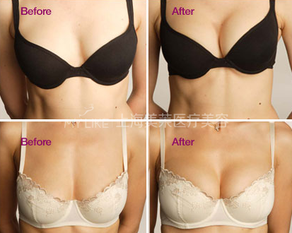 为什么女人爱隆胸?