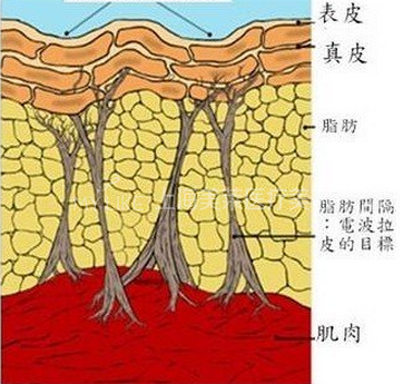 激光术