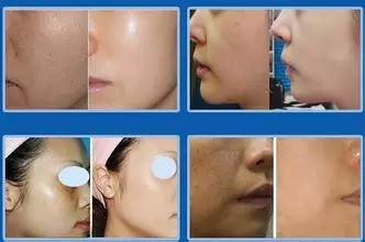 别等皮肤这样了,才想起打水光