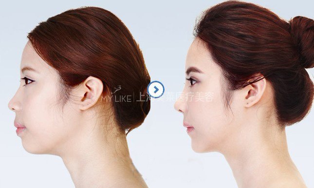 突嘴究竟需不需要做手术?