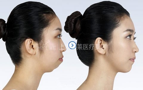 突嘴究竟需不需要做手术?