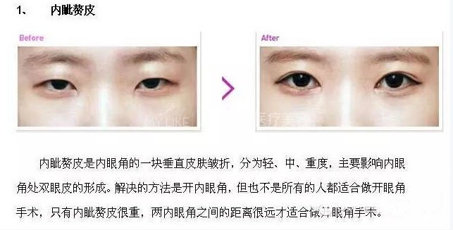 跟单眼皮道别,让双眼皮帮你解决八大眼部问题