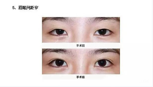跟单眼皮道别,让双眼皮帮你解决八大眼部问题