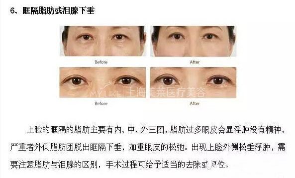 跟单眼皮道别,让双眼皮帮你解决八大眼部问题